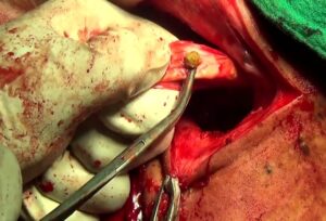 Removal of caliculi via urethrotomy