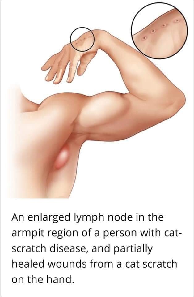 Cat scratch disease CSD