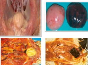 GUMBORO DISEASE (IBD)