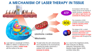 Laser Therapy