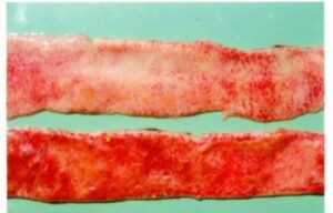 Figure 6 Enteritis of small intestine, showing mucosal ulcerations with hemorrhage