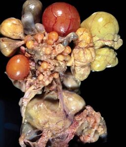 Figure7 Ovarian lesions, salpingitis, and peritonitis.